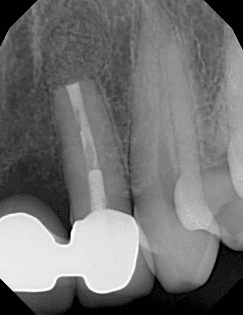 Endodontic surgery post-op radiograph by Cincinnati endodontist Dr. Sullivan of Mason Endodontics and Microsurgery