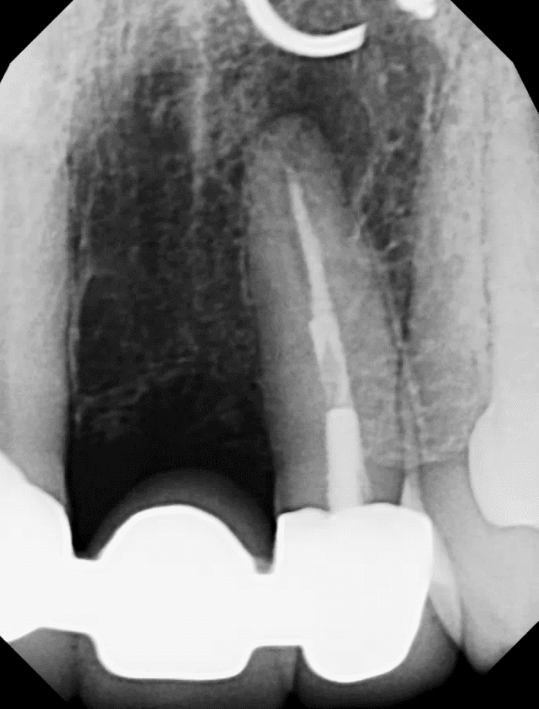 Tooth #10 apical microsurgery pre-op by Cincinnati endodontist Dr. Sullivan of Mason Endodontics and Microsurgery