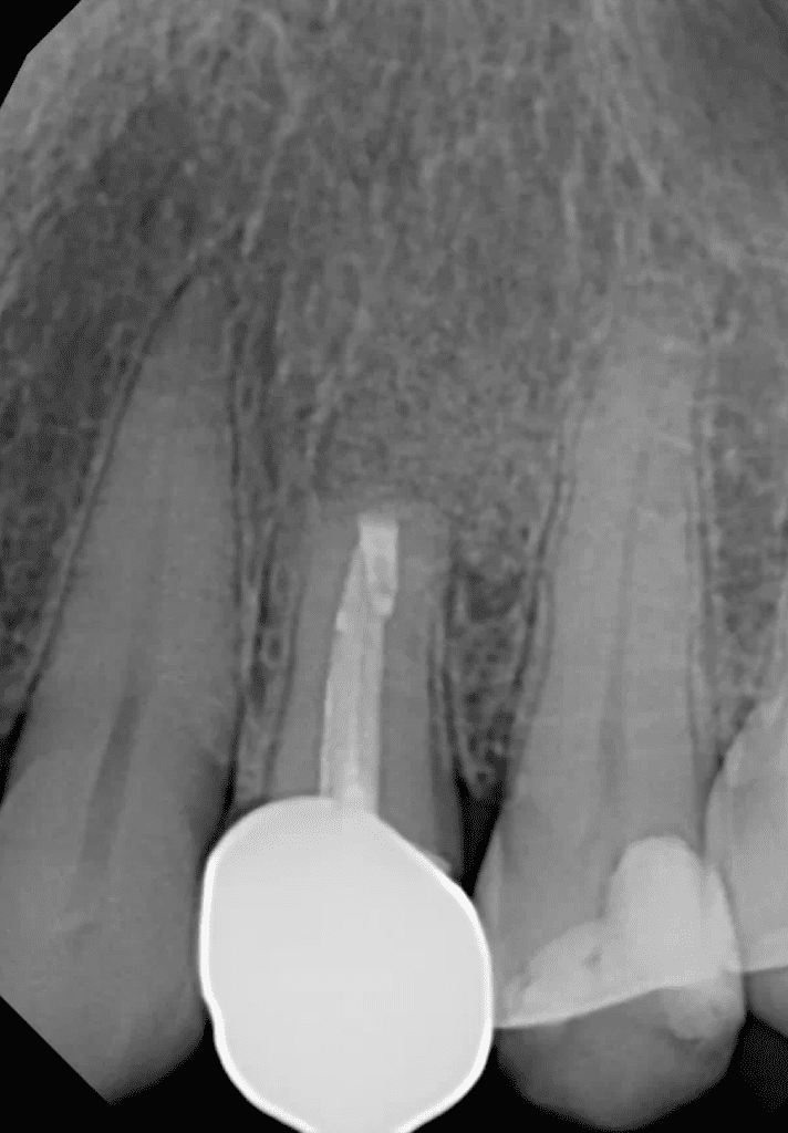 #12 Apical surgery post-op by Dr. Matthew Sullivan