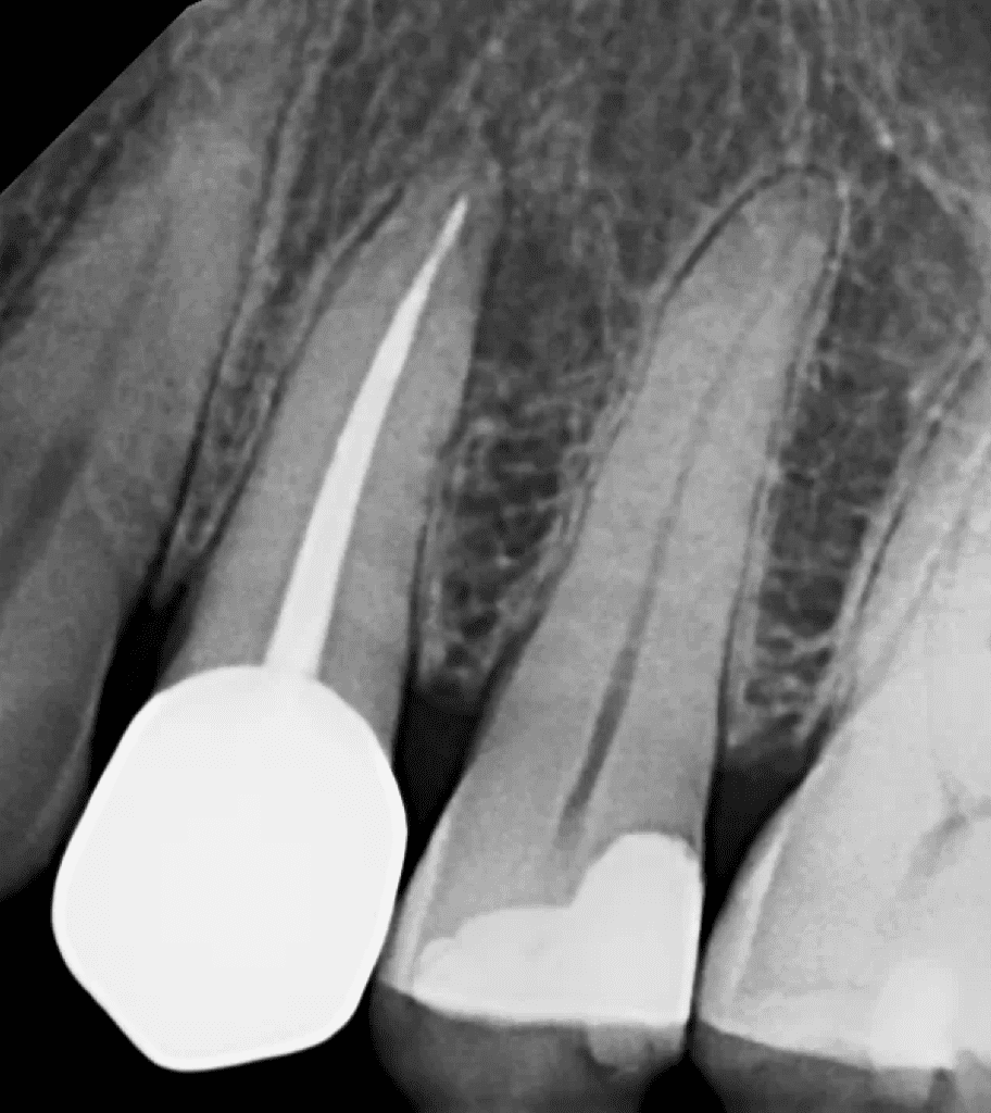 #12 apical surgery pre-op showing lateral canal by Cincinnati endodontist Dr. Sullivan of Mason Endodontics and Microsurgery