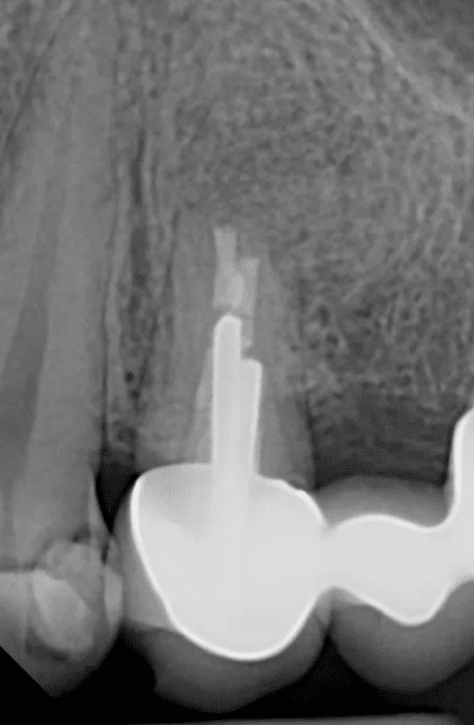 Complete healing of tooth #12 after apical endodontic microsurgery or apicoectomy by Dr. Matthew Sullivan of Mason Endodontics and Microsurgery