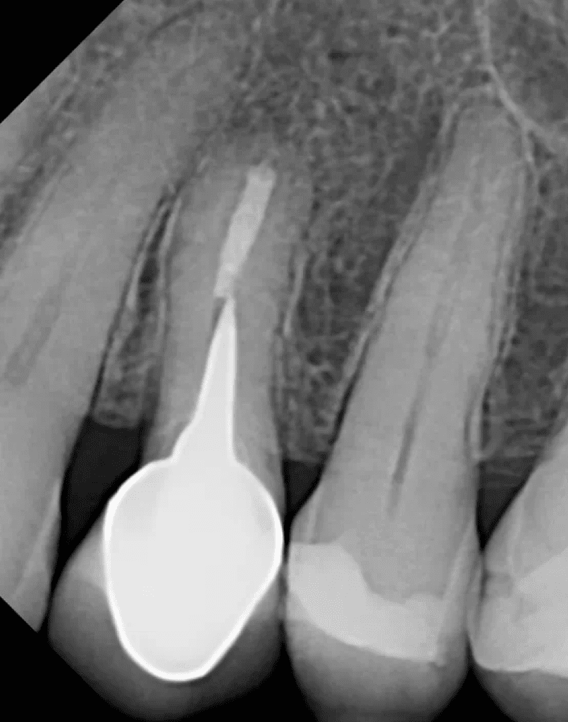 Endodontic surgery and bone grafting completed by Cincinnati endodontist Dr. Sullivan of Mason Endodontics and Microsurgery