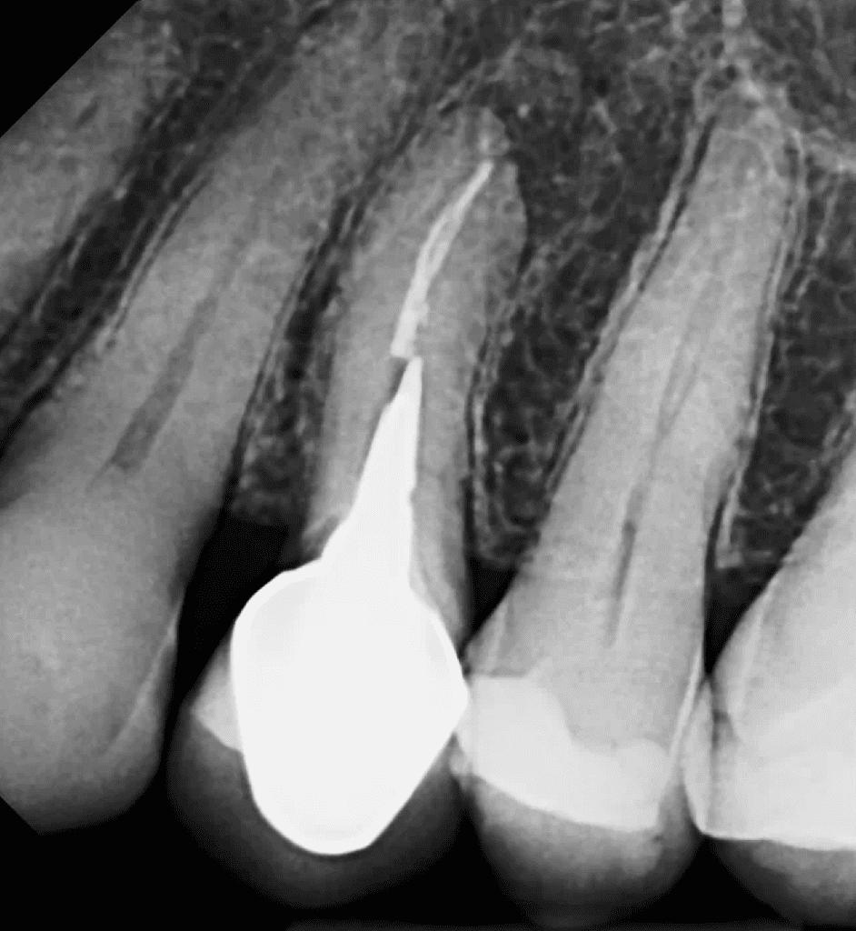 Pre-op endodontic surgery toth #12 by Cincinnati endodontist Dr. Sullivan of Mason Endodontics and Microsurgery