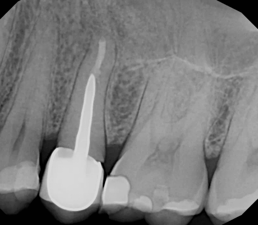 Endodontic surgery completed by Cincinnati endodontist Dr. Matthew Sullivan of Mason Endodontics and Microsurgery