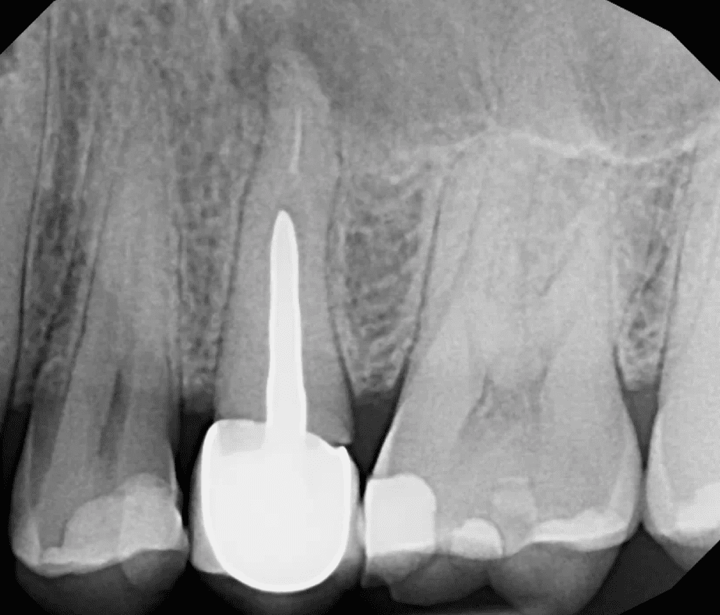 Roto canal surgery pre-op xray by Cincinnati endodontist Dr. Sullivan of Mason Endodontics and Microsurgery