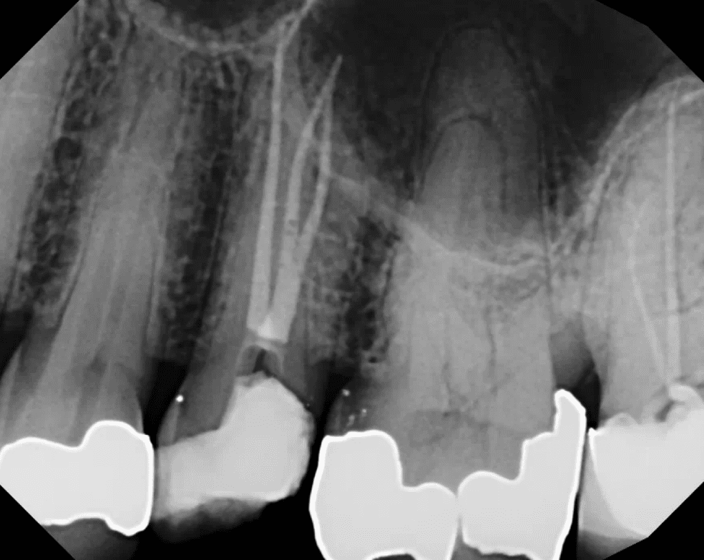 Upper bicuspid root canal completed by Cincinnati endodontist Dr. Sullivan of Mason Endodontics and Microsurgery - 3 canals with buccal canal having 1-2-1 configuration.