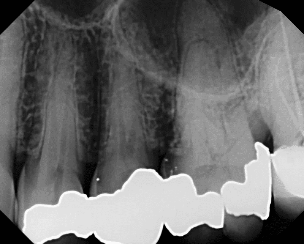 Tooth #13 root canal pre-op radiograph by Cincinnati endodontist Dr. Sullivan of Mason Endodontics and Microsurgery