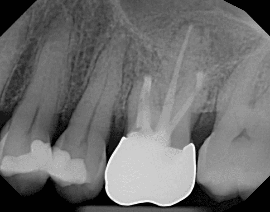Endodontic surgery (apicoectomy) by Cincinnati endodontist Dr. Sullivan of Mason Endodontics and Microsurgery