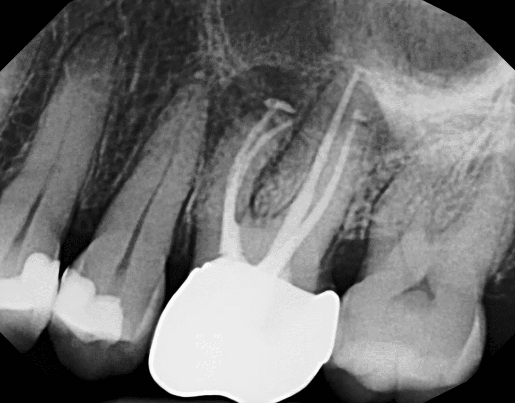 Tooth #14 apicoectomy surgery pre-op by Cincinnati endodontist Dr. Sullivan of Mason Endodontics and Microsurgery