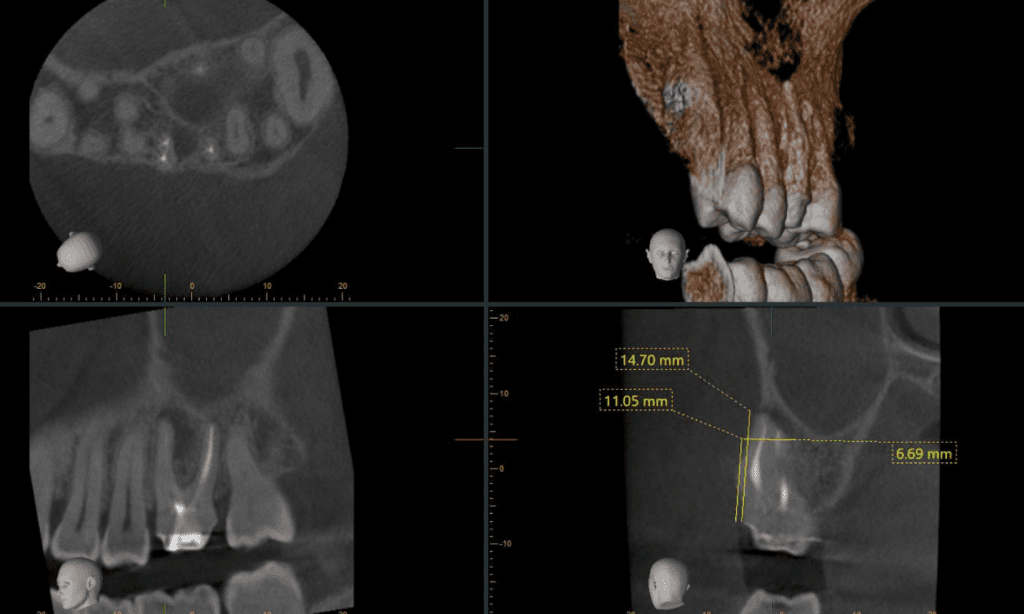 CBCT apical surgery treatment plan at Mason Endodontics and Microsurgery in Cincinnati, Ohio