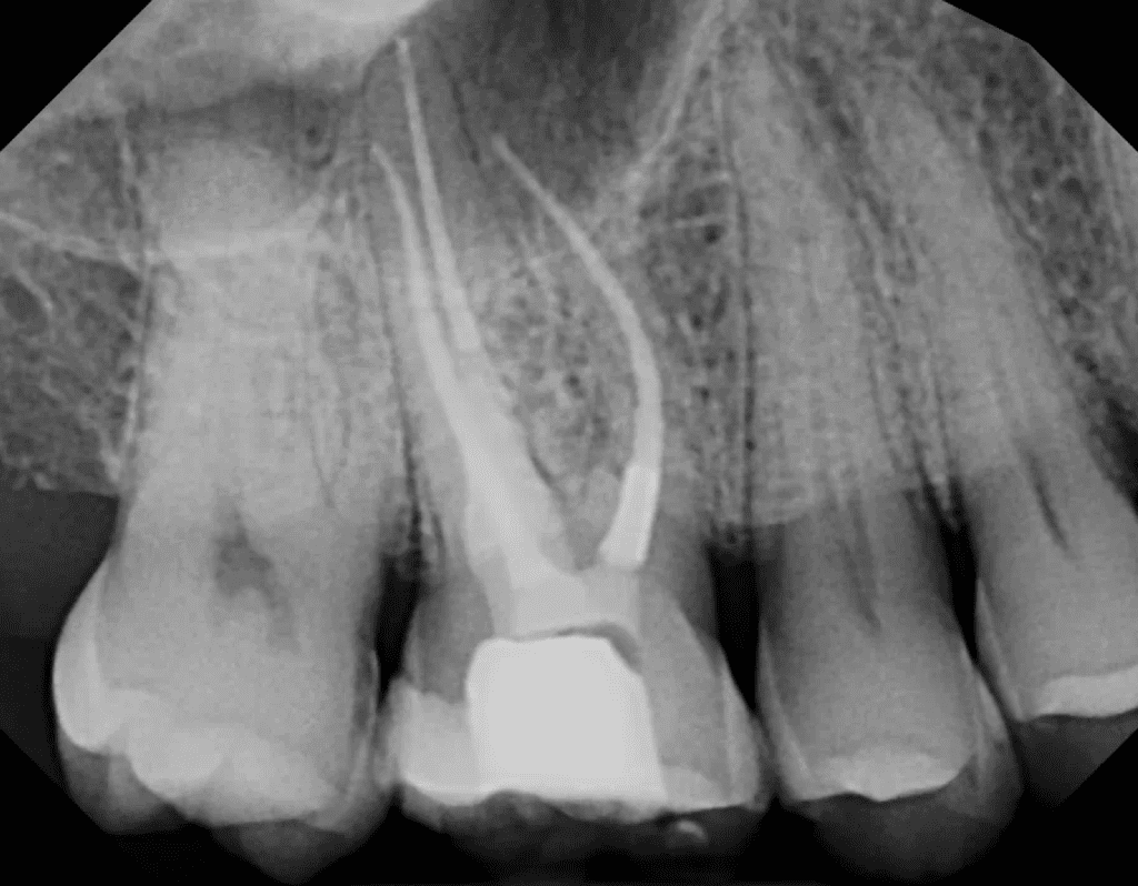 Tooth root resorption #3 treated by Dr. Matthew Sullivan of Mason Endodontics and Microsurgery
