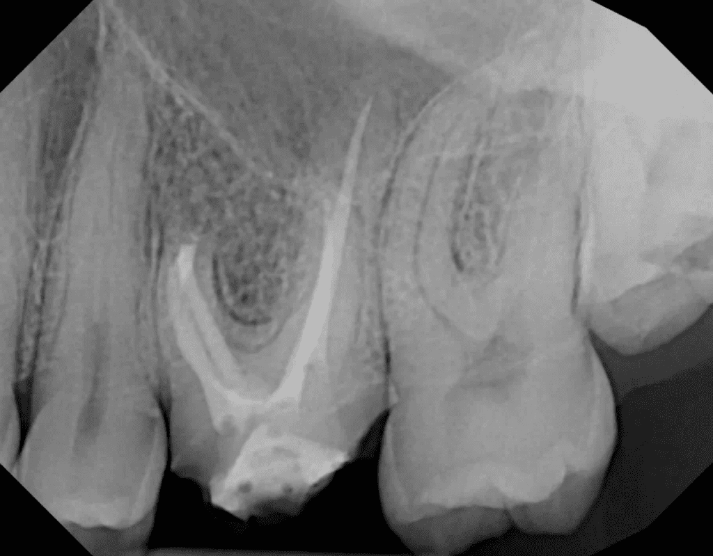Apicoectomy post-op xray by Cincinnati endodontist Dr. Sullivan of Mason Endodontics and Microsurgery