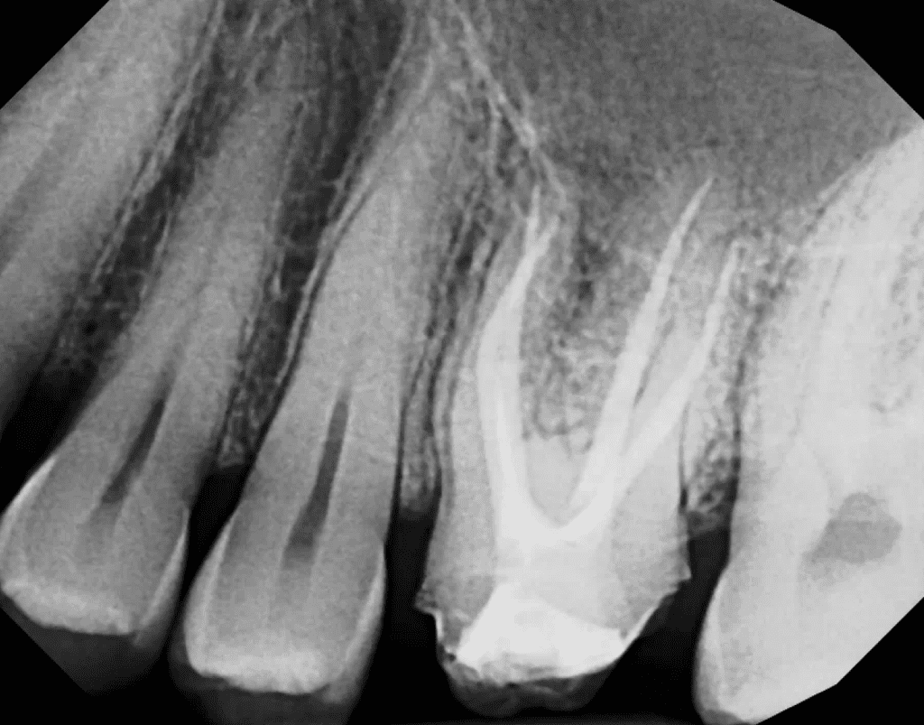 Apicoectomy pre-op xray by Cincinnati endodontist Dr. Sullivan of Mason Endodontics and Microsurgery