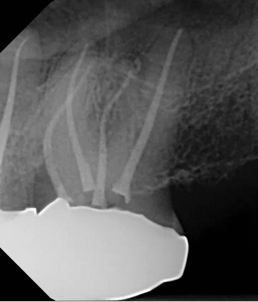 Root canal completed by Cincinnati endodontist Dr. Matthew Sullivan of Mason Endodontics and Microsurgery