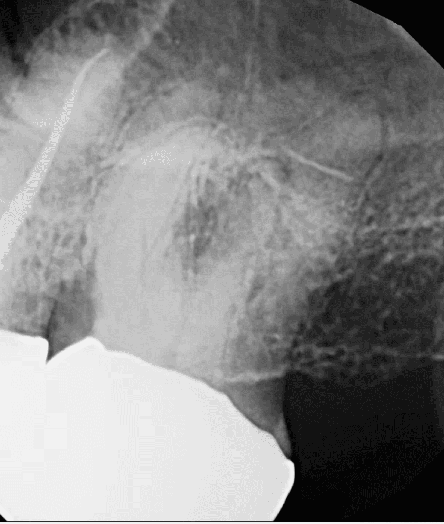 Tooth #15 endo pre-op by Cincinnati endodontist Dr. Sullivan of Mason Endodontics and Microsurgery.