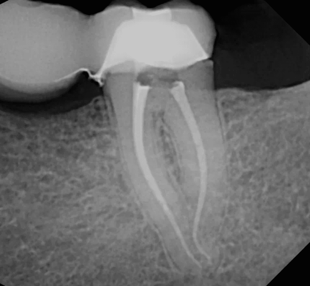 Molar root canal completed by Dr. Sullivan. Curvy and calcified root canal.