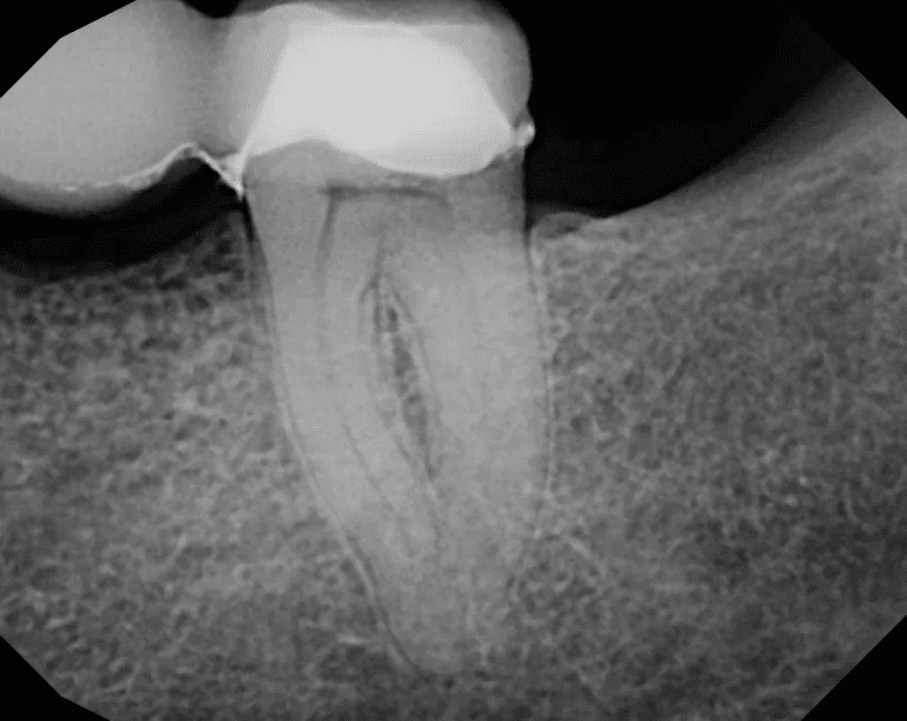 Tooth #18 root canal pre-op by Cincinnati endodontist Dr. Sullivan of Mason Endodontics and Microsurgery
