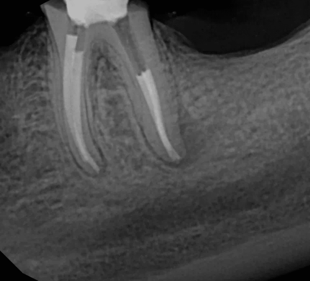 #18 root canal retreatment completed by Dr. Matthew Sullivan of Mason Endodontics and Microsurgery