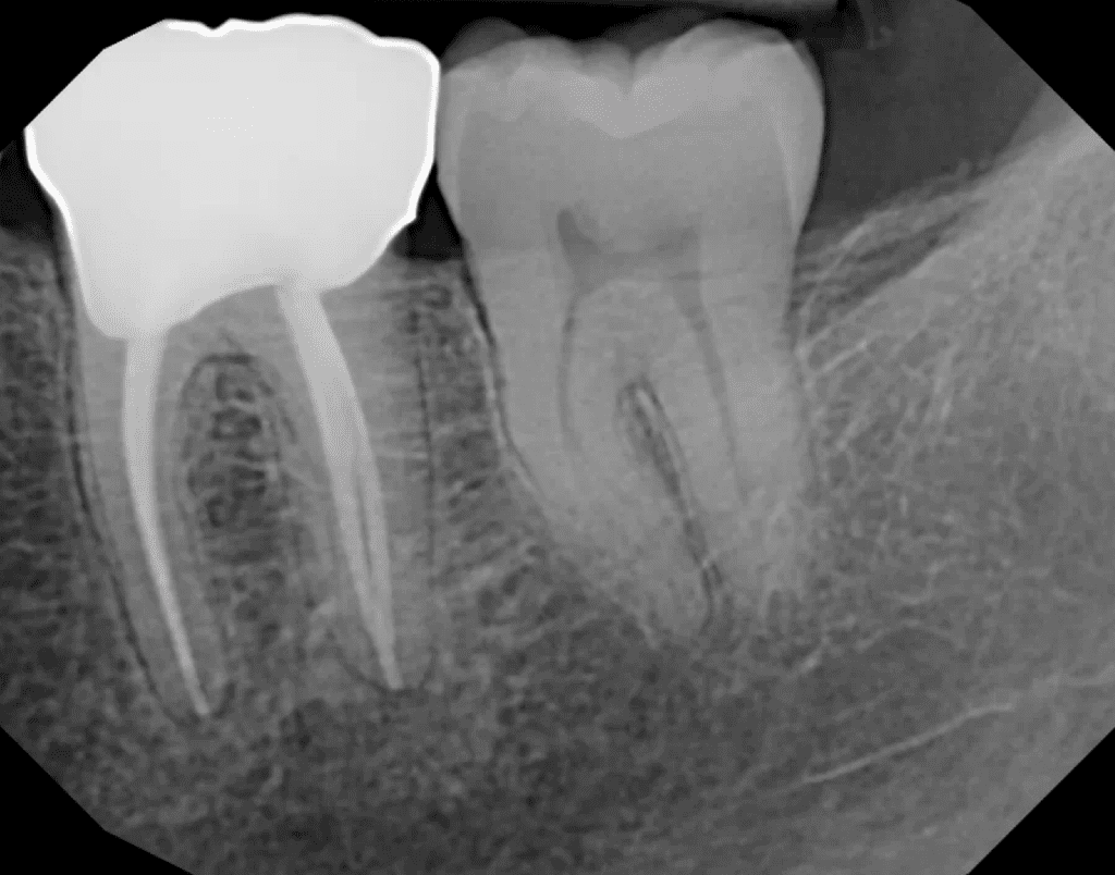 Root canal completed by Cincinnati endodontist Dr. Sullivan of Mason Endodontics and Microsurgery