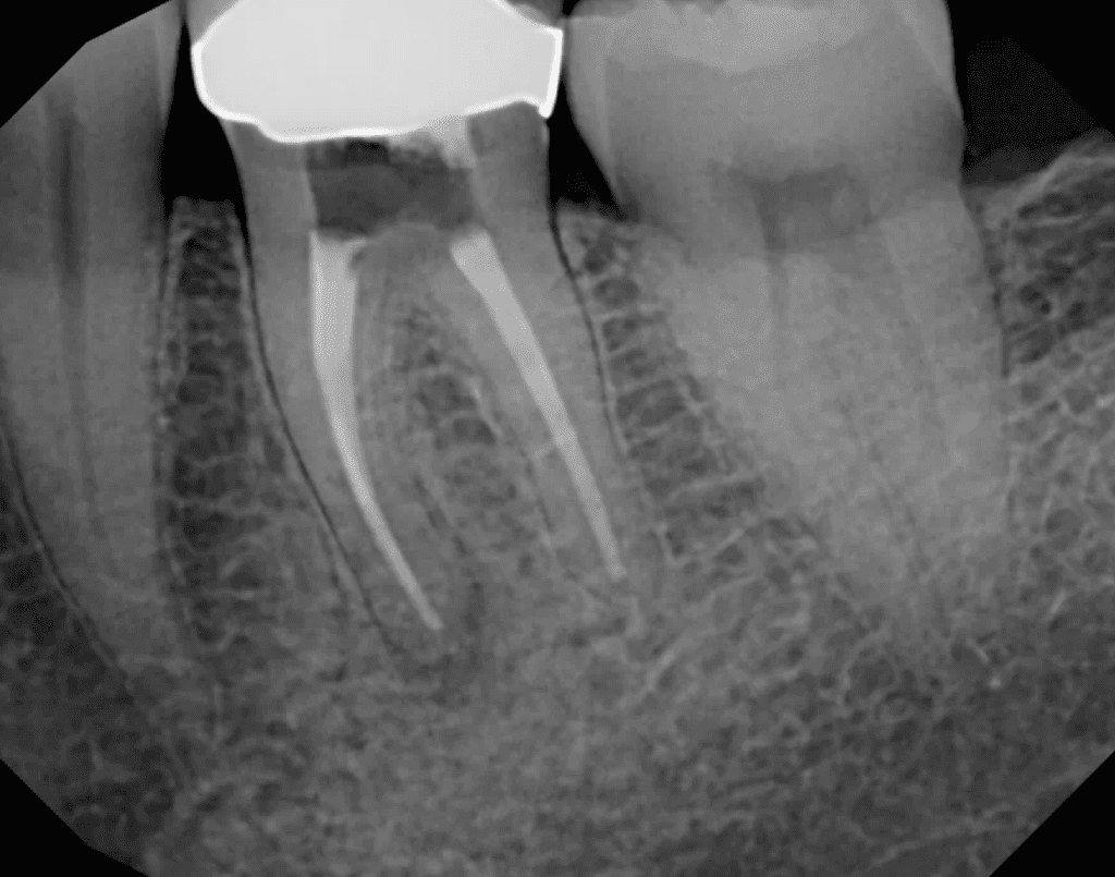 Tooth #19 root canal retreatment with silver points post-op by Cincinnati endodontist Dr. Sullivan of Mason Endodontics and Microsurgery