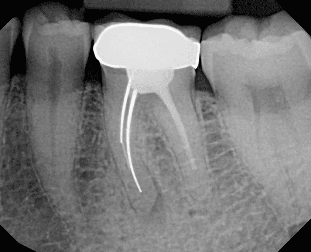 Tooth #19 root canal with silver points prior to endodontic retreatment by Cincinnati endodontist Dr. Sullivan of Mason Endodontics and Microsurgery