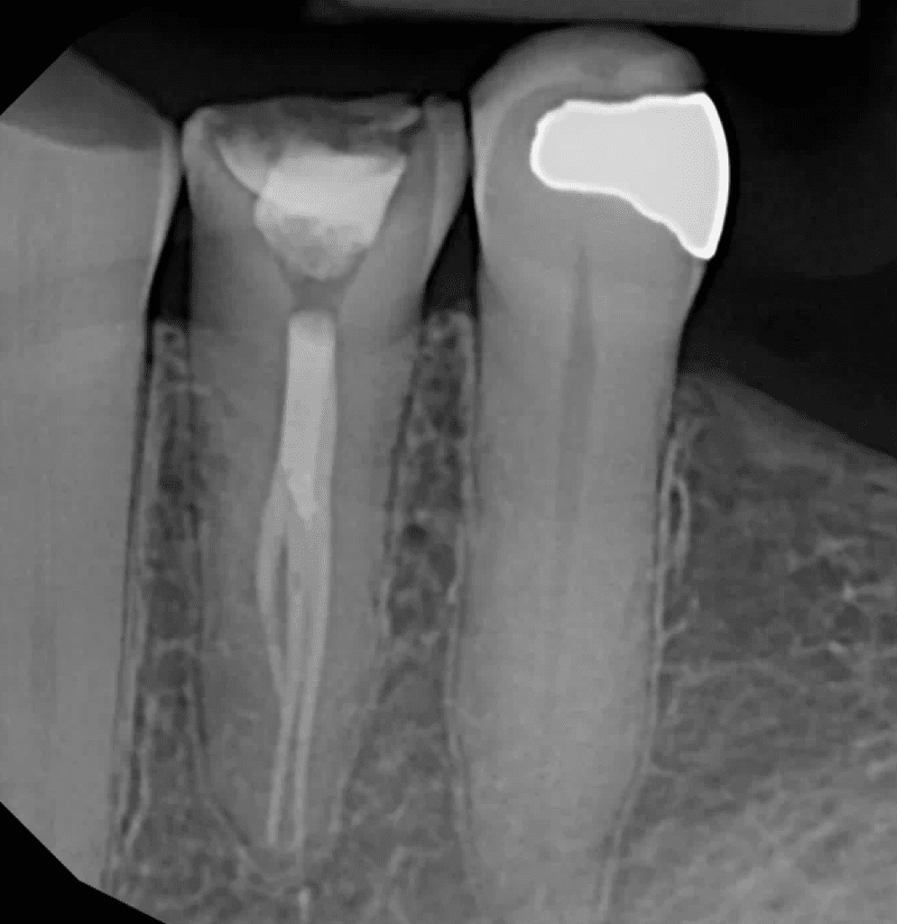 Complex root canal completed by Cincinnati endodontist Dr. Sullivan of Mason Endodontics and Microsurgery with the use of the surgical operating microscope.