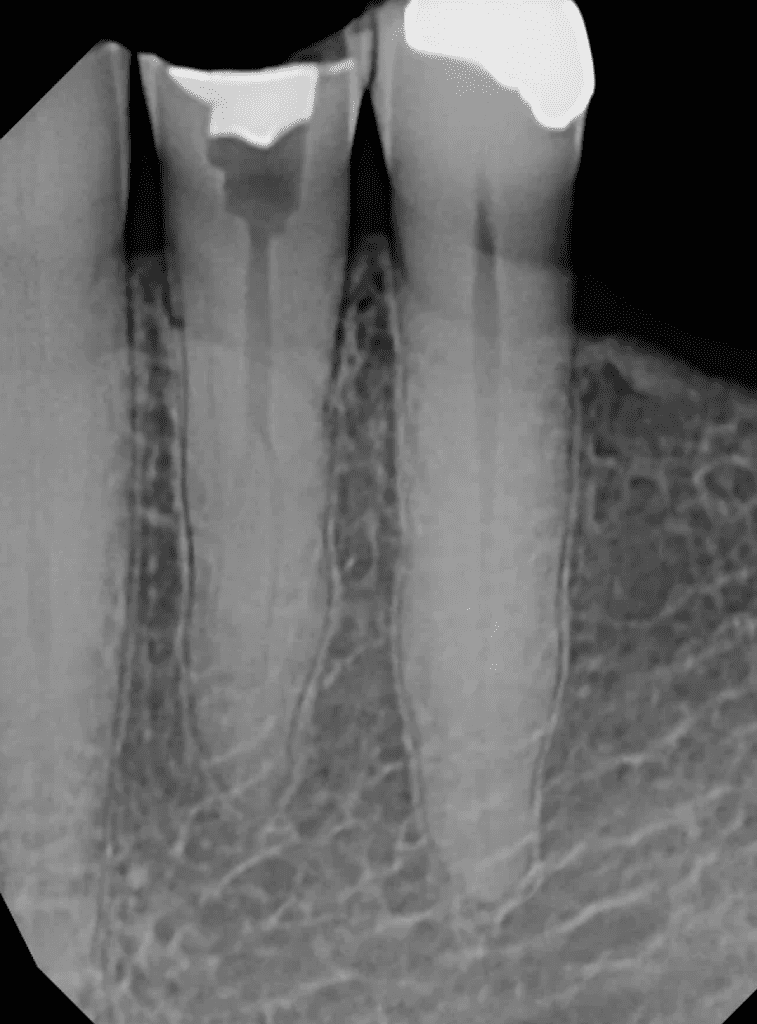 Deep split 3 canal lower premolar treated by Cincinnati Endodontist Dr. Matthew Sullivan