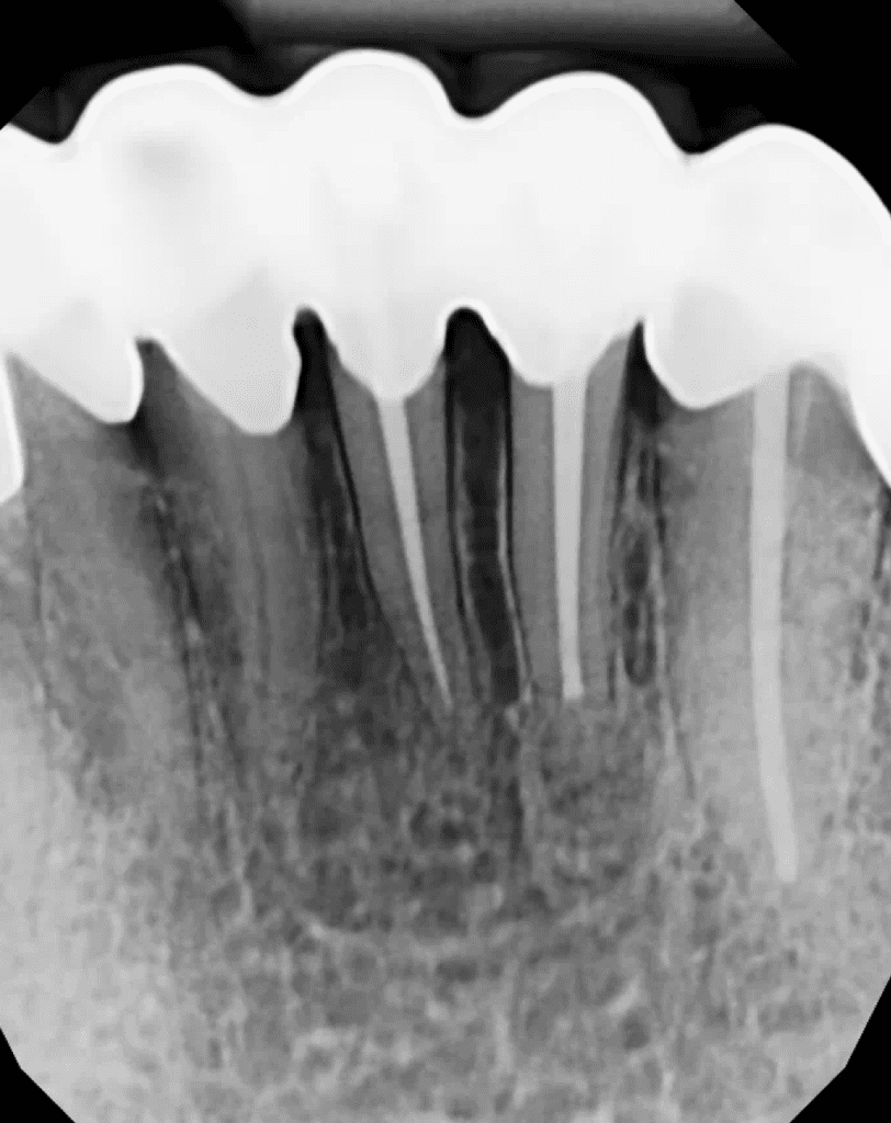 Tooth #23 endodontic surgery completed by Cincinnati endodontist Dr. Sullivan of Mason Endodontics and Microsurgery.