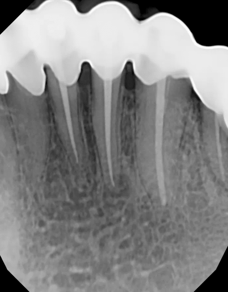 Tooth #23 endodontic surgery pre-op by Cincinnati endodontist Dr. Sullivan of Mason Endodontics and Microsurgery