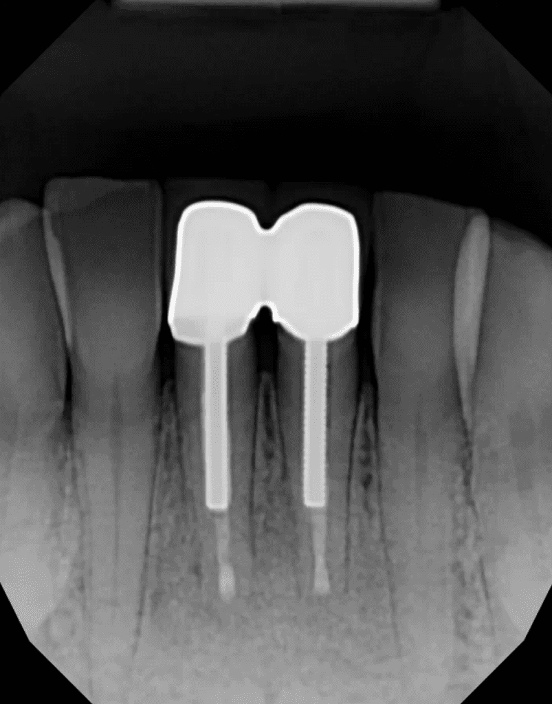 Complete healing after apical endodontic microsurgery by Dr. Matthew Sullivan of Mason Endodontics and Microsurgery
