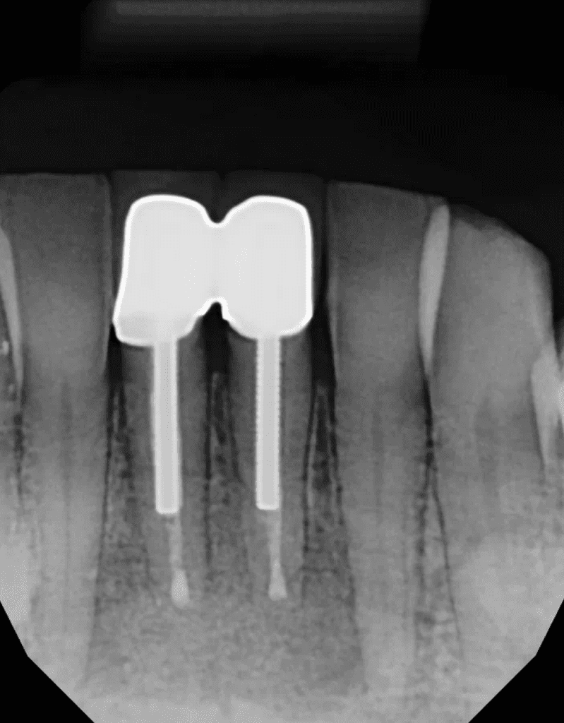 Mandibular incisors post-op xray after endodontic surgery by Cincinnati endodontist Dr. Sullivan of Mason Endodontics and Microsurgery