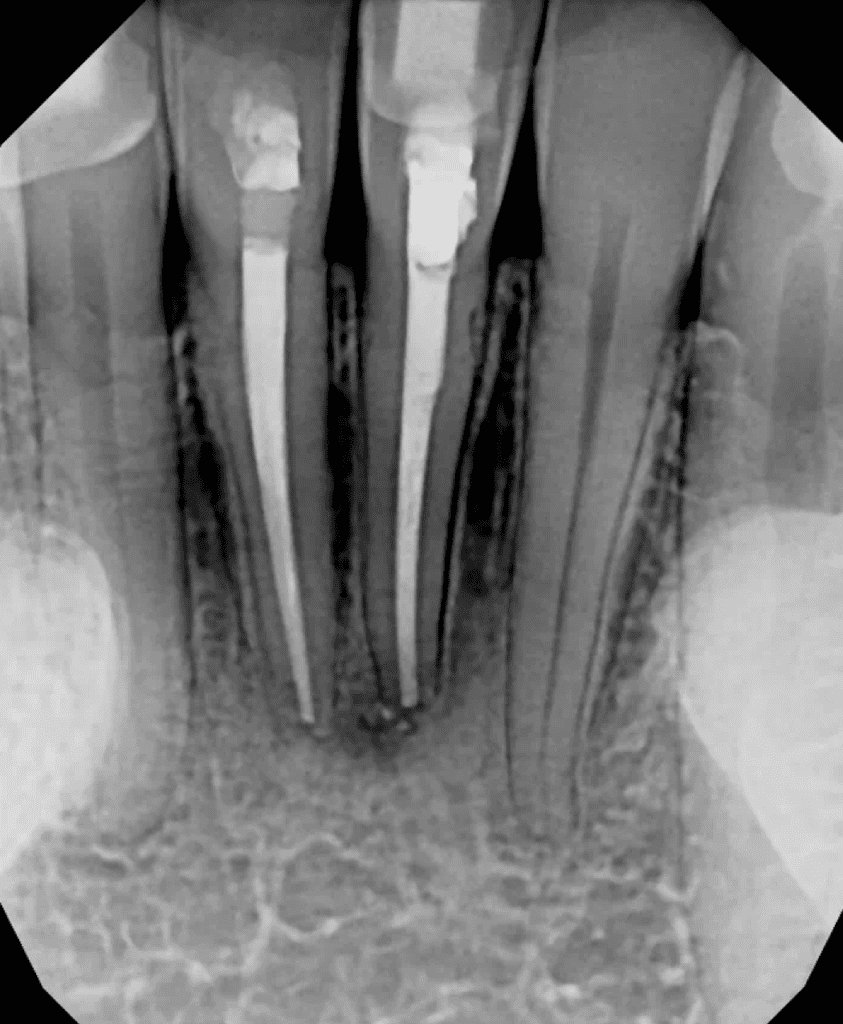 Mandibular incisors pre-op xray before endodontic surgery by Cincinnati endodontist Dr. Sullivan of Mason Endodontics and Microsurgery