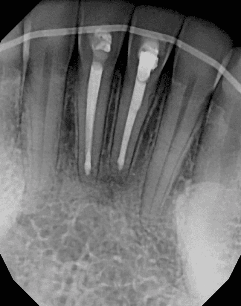 Mandibular incisors 6-month recall showing excellent healing after endodontic surgery by Cincinnati endodontist Dr. Sullivan of Mason Endodontics and Microsurgery