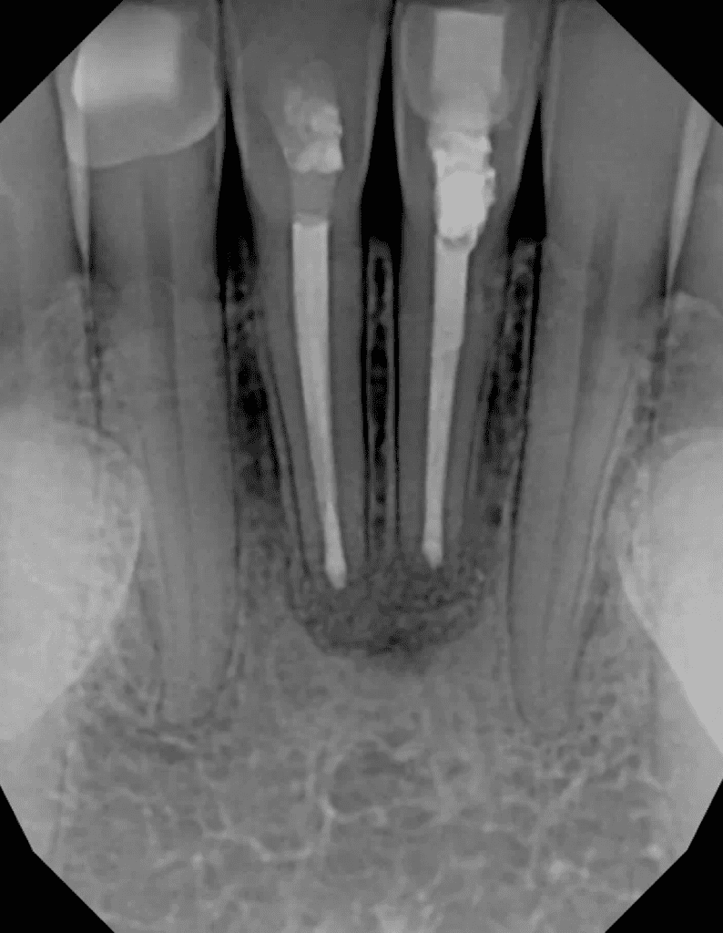 Mandibular incisors post-op xray after endodontic surgery by Cincinnati endodontist Dr. Sullivan of Mason Endodontics and Microsurgery
