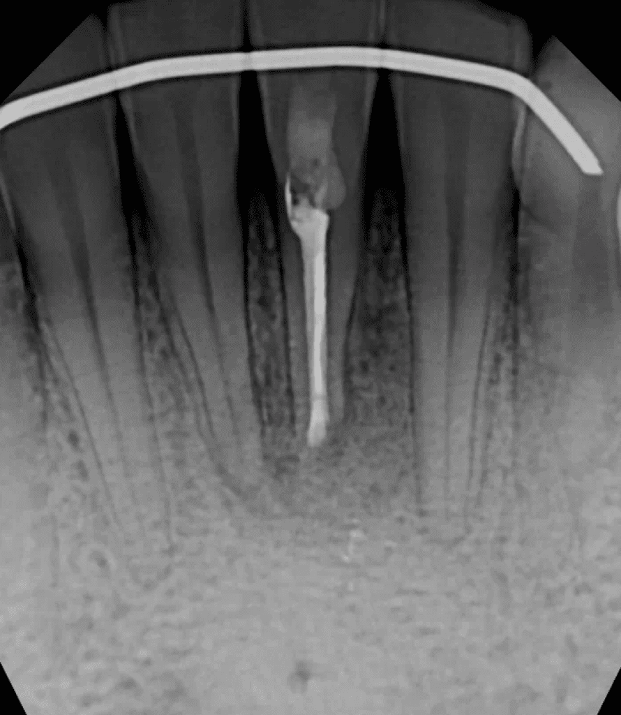 Tooth #24 apicoectomy post-op