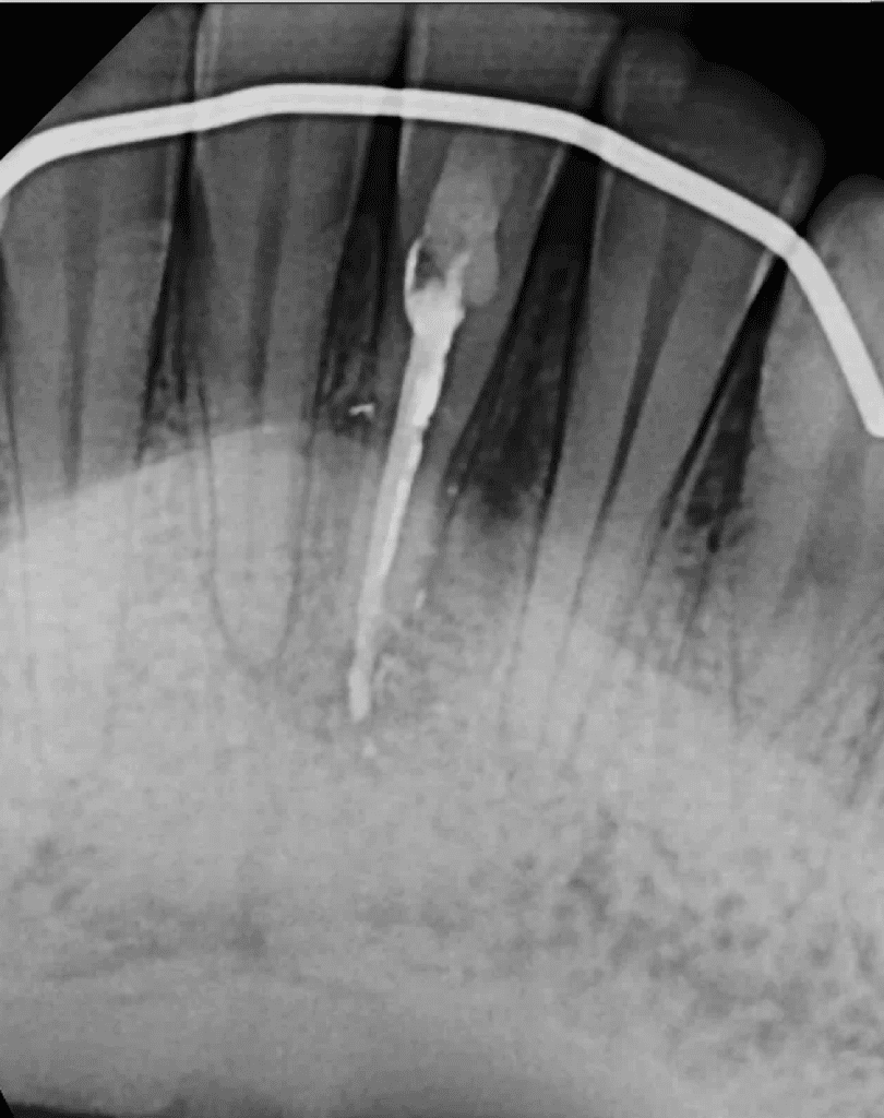 Tooth #24 apicoectomy pre-op
