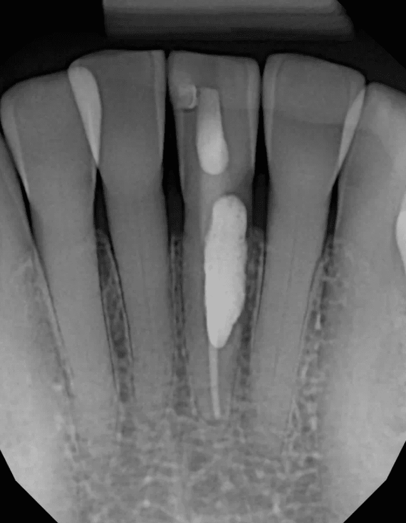 Mandibular incisor post-op root canal and resorption repair by Cincinnati endodontist Dr. Sullivan of Mason Endodontics and Microsurgery
