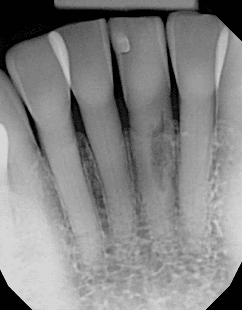Mandibular incisor pre-op root canal and resorption repair by Cincinnati endodontist Dr. Sullivan of Mason Endodontics and Microsurgery