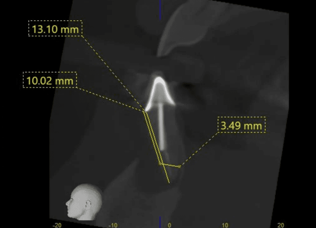CBCT treatment planning. 
 Mandibular incisor (tooth #25) with large post pre-op endodontic surgery by Cincinnati endodontist Dr. Sullivan of Mason Endodontics and Microsurgery