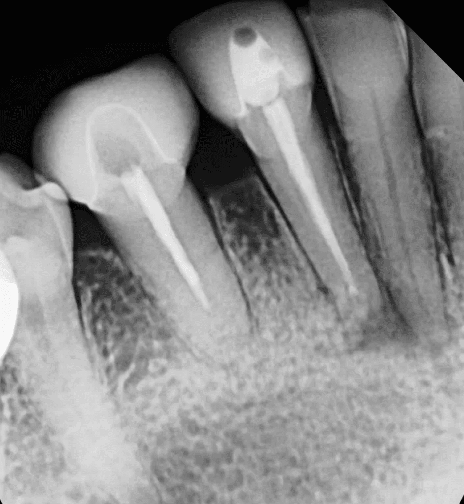 Mandibular incisors pre-op root canal, retreatment, and endodontic surgery by Cincinnati endodontist Dr. Sullivan of Mason Endodontics and Microsurgery