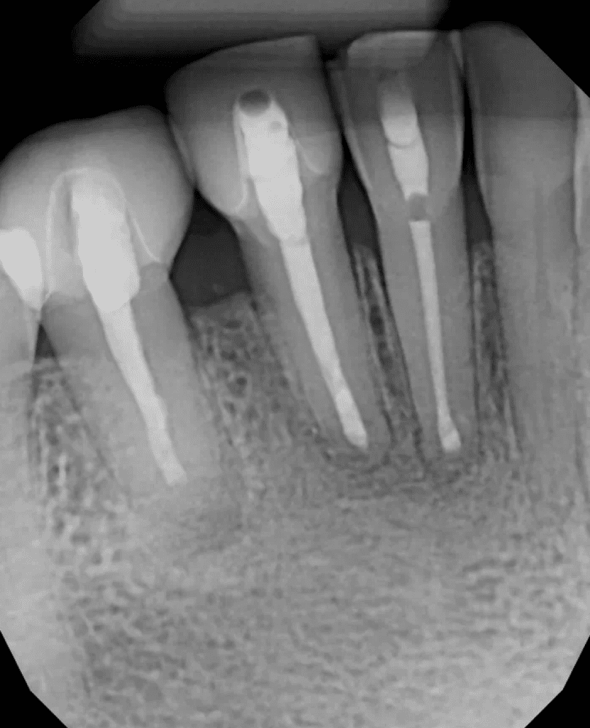 Mandibular incisors 6-month recall root canal, retreatment, and endodontic surgery by Cincinnati endodontist Dr. Sullivan of Mason Endodontics and Microsurgery.  Excellent healing seen.