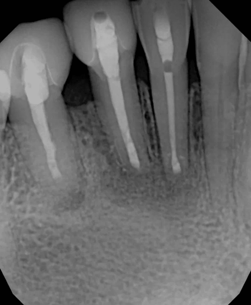 Mandibular incisors post-op after root canal, retreatment, and endodontic surgery by Cincinnati endodontist Dr. Sullivan of Mason Endodontics and Microsurgery