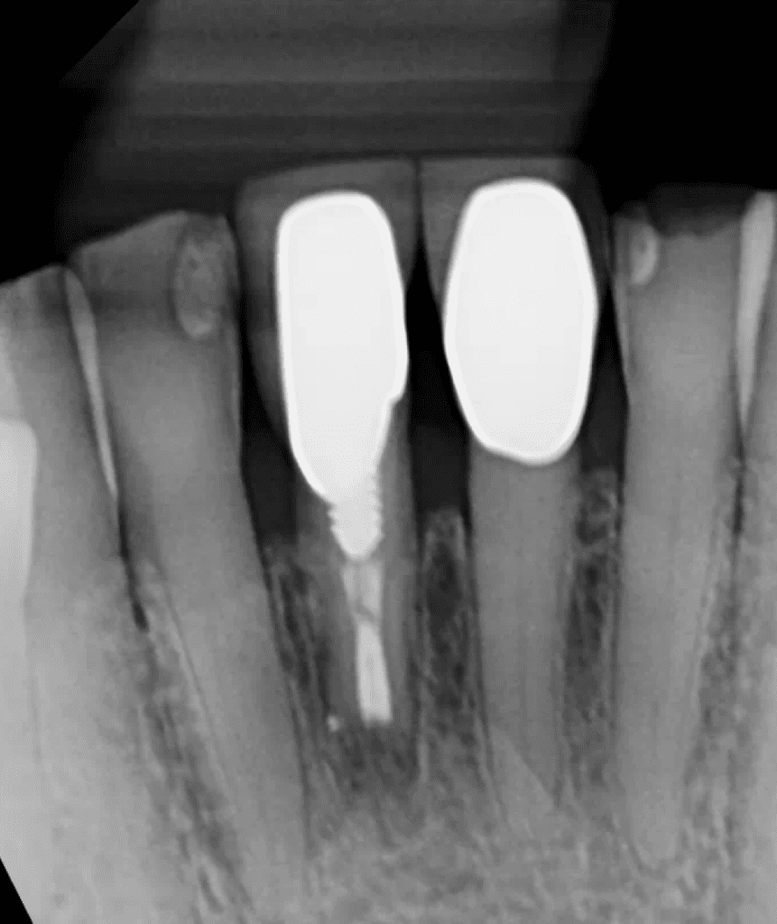 Mandibular incisor (tooth #25) with large post post-op endodontic surgery by Cincinnati endodontist Dr. Sullivan of Mason Endodontics and Microsurgery