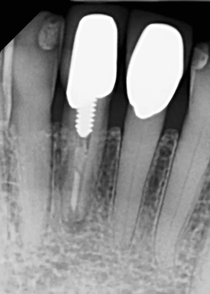 Mandibular incisor (tooth #25) with large post pre-op endodontic surgery by Cincinnati endodontist Dr. Sullivan of Mason Endodontics and Microsurgery