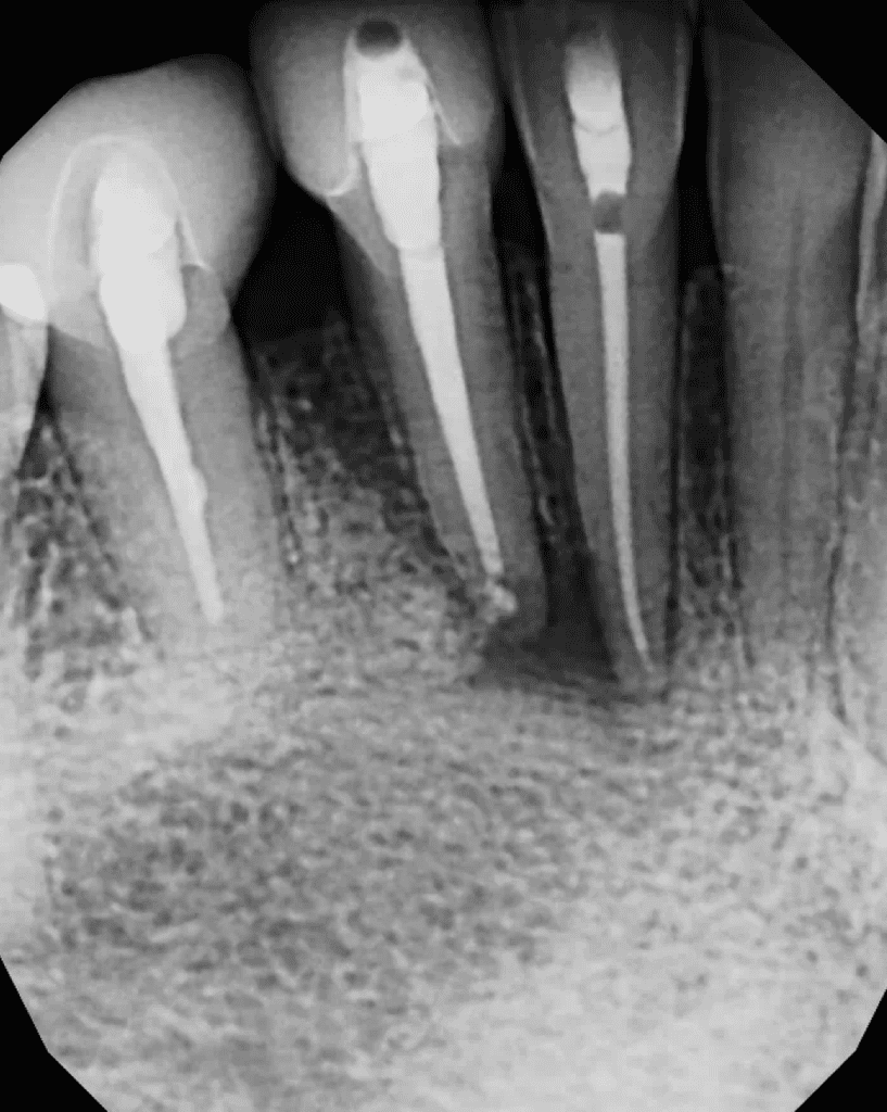 Mandibular incisors post-op root canal, retreatment, and endodontic surgery by Cincinnati endodontist Dr. Sullivan of Mason Endodontics and Microsurgery