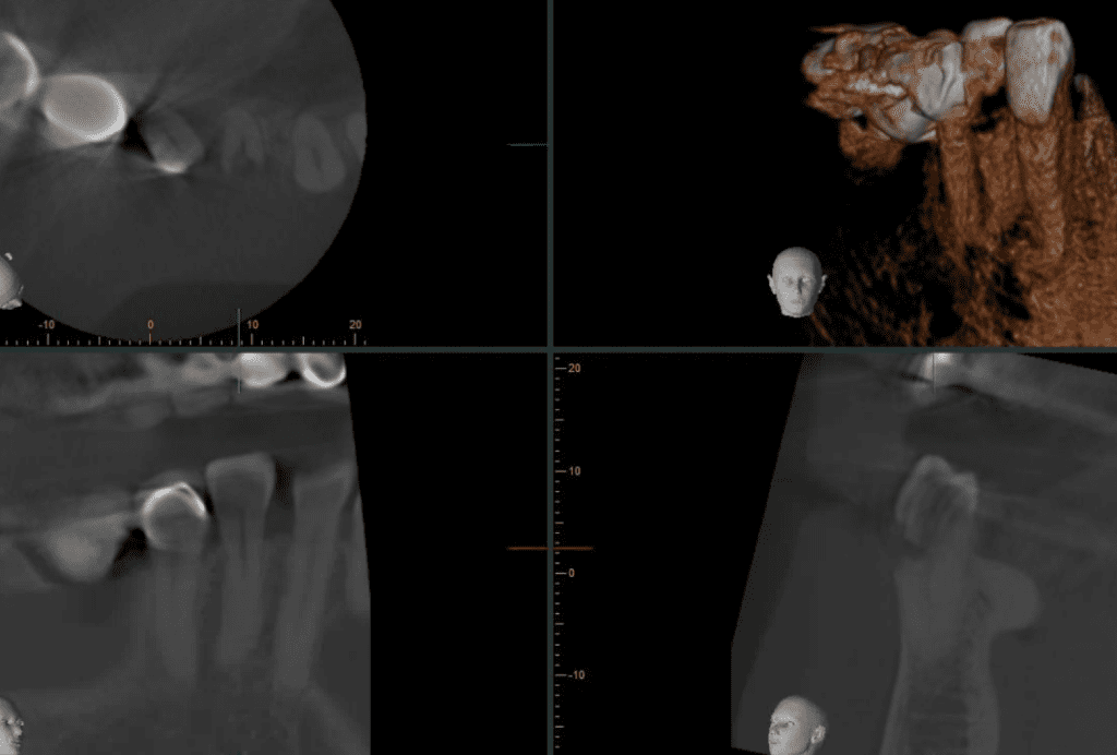 CBCT slice - Tooth #28 resorption pre-op by Cincinnati endodontist Dr. Sullivan of Mason Endodontics and Microsurgery