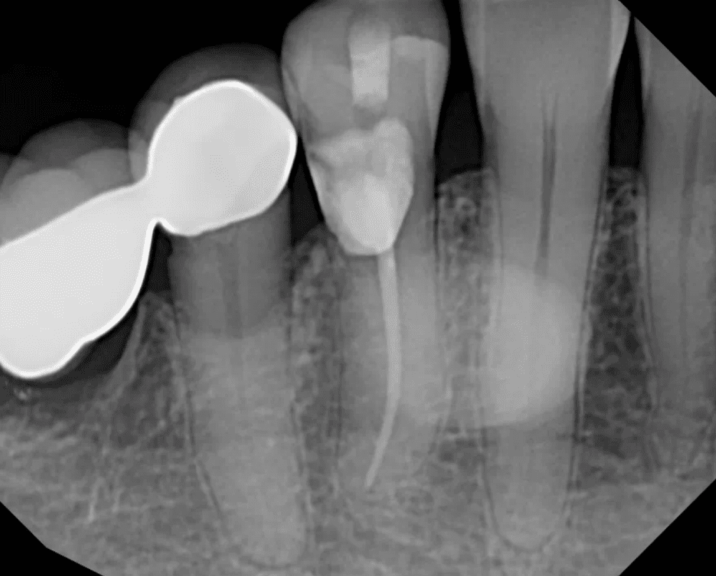 Tooth #28 resorption repair and root canal by Cincinnati endodontist Dr. Sullivan of Mason Endodontics and Microsurgery