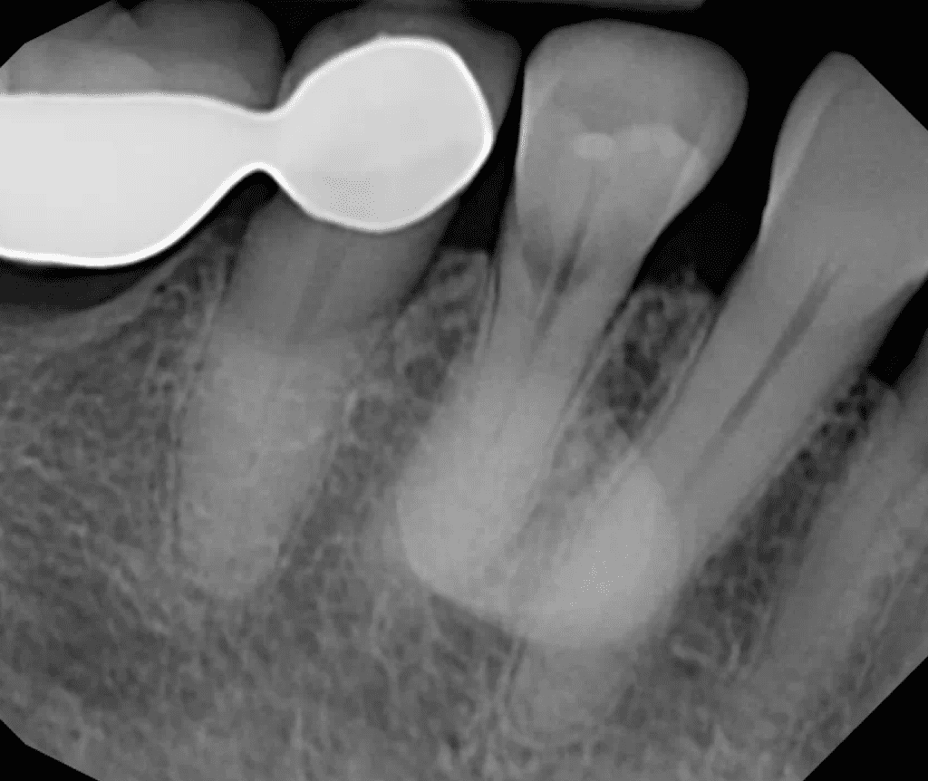Tooth #28 resorption pre-op by Cincinnati endodontist Dr. Sullivan of Mason Endodontics and Microsurgery