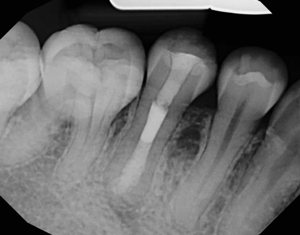 Tooth #29 dens evaginatus 6-month recall with MTA obturation by Cincinnati endodontist Dr. Sullivan of Mason Endodontics and Microsurgery