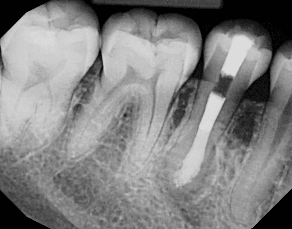 Tooth #29 dens evaginatus post-op with MTA obturation by Cincinnati endodontist Dr. Sullivan of Mason Endodontics and Microsurgery